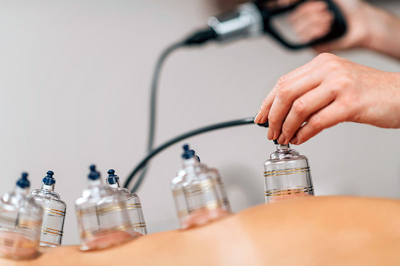 Cupping Therapy Greenville